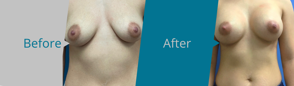 breast augmentation mcallen and san Antonio tx