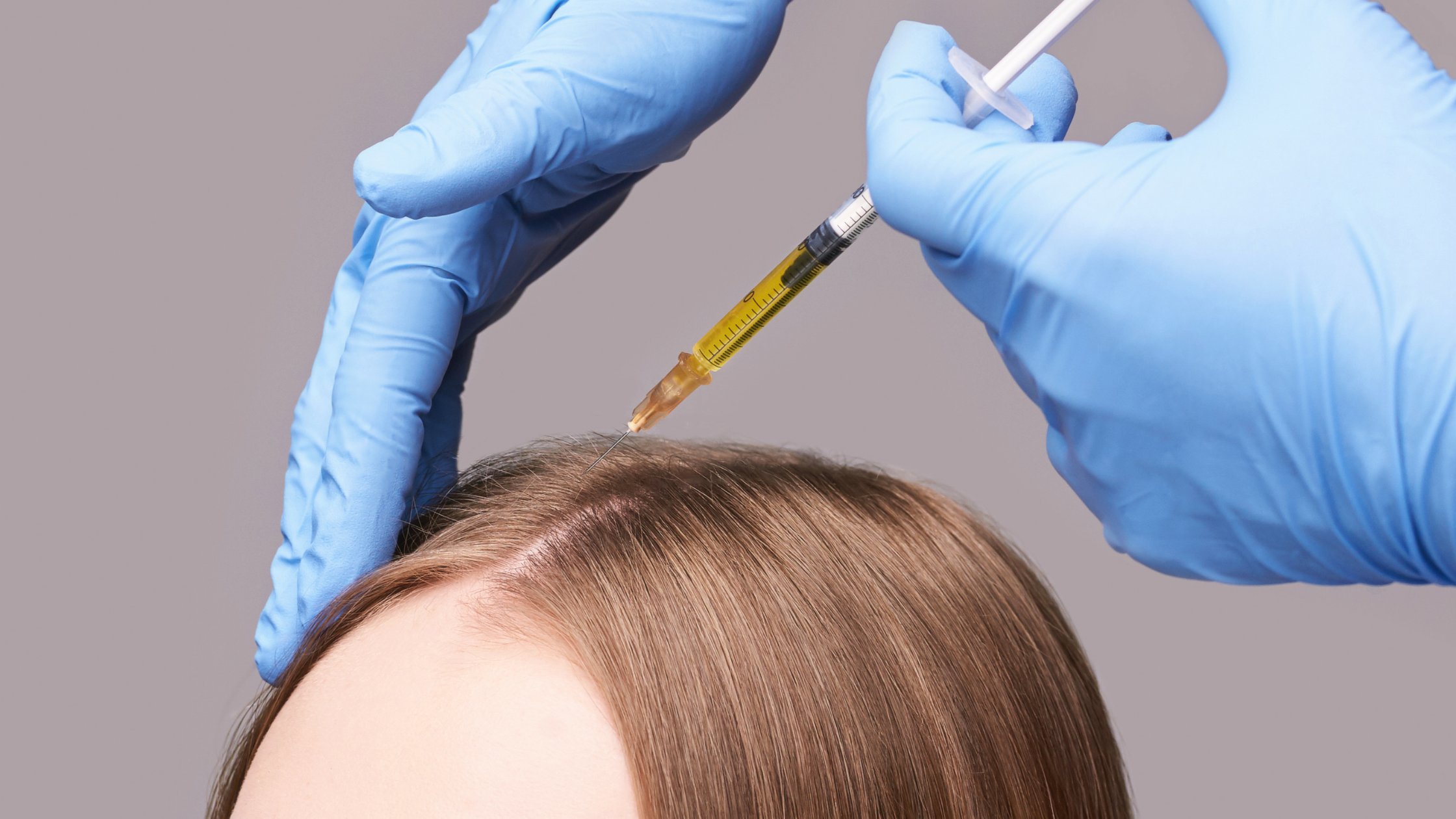 5 Things You Should Know About PRP Hair Injections
