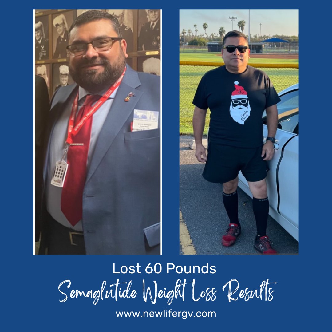 Semaglutide Weight Loss - before and after