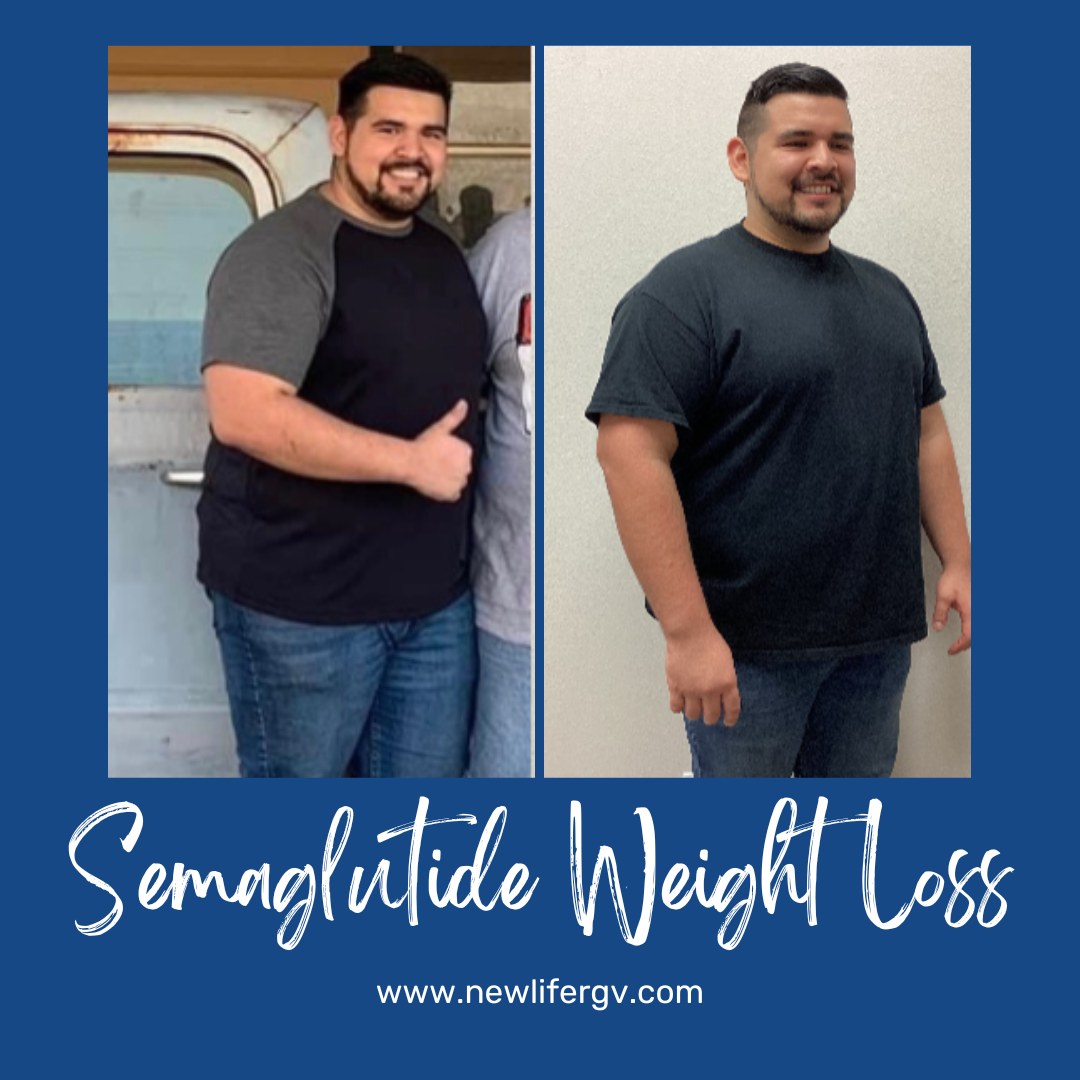 Semaglutide Weight Loss - before and after
