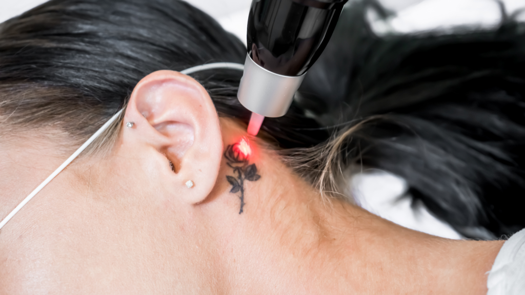 3 Benefits of Tattoo Removal Using Q-Switched Lasers vs. Regular Lasers 