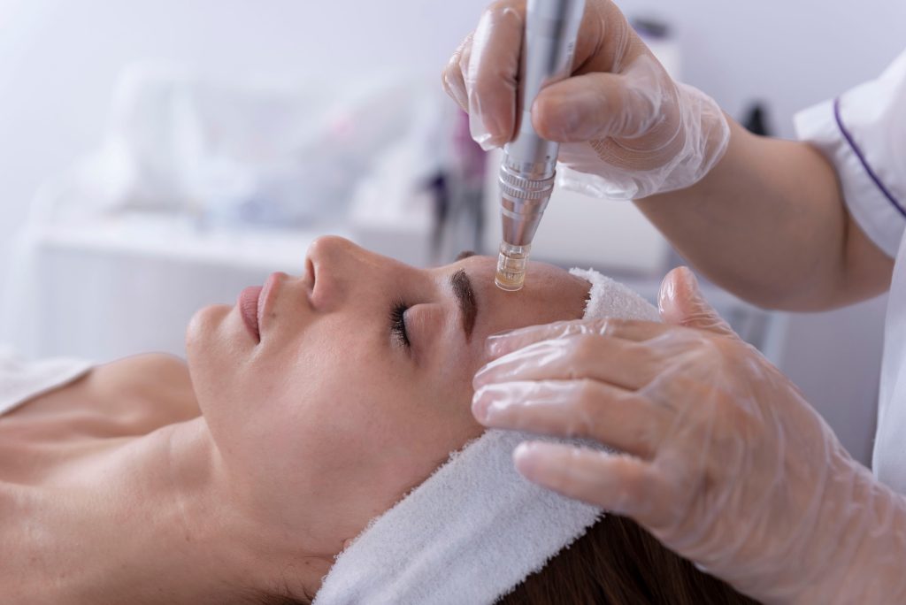 plasma pen microneedling