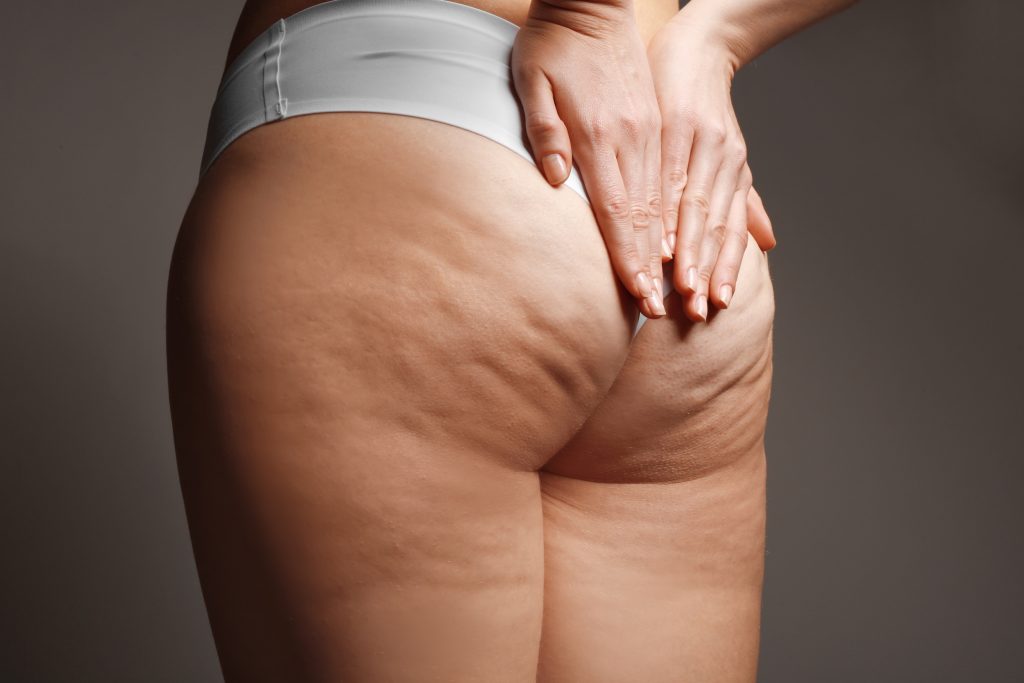 cellulite treatment mcallen