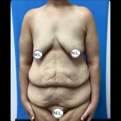 Breast Lift Before & After Patient #14844