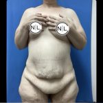 Abdominoplasty Before & After Patient #14743