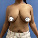 Breast Reduction Before & After Patient #15428