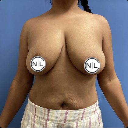 Breast Reduction Before & After Patient #15428