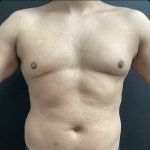 Gynecomastia Before & After Patient #15429