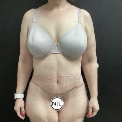 Abdominoplasty Before & After Patient #14743