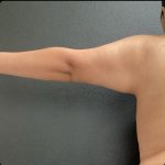 Brachioplasty Before & After Patient #15427