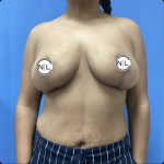 Breast Reduction Before & After Patient #15428