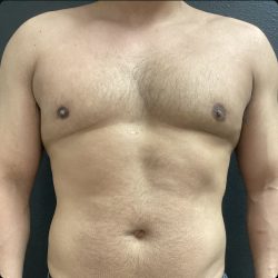 Gynecomastia Before & After Patient #15429