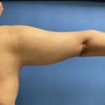 Liposuction Before & After Patient #15186