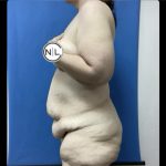 Abdominoplasty Before & After Patient #14743