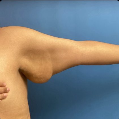 Brachioplasty Before & After Patient #15427