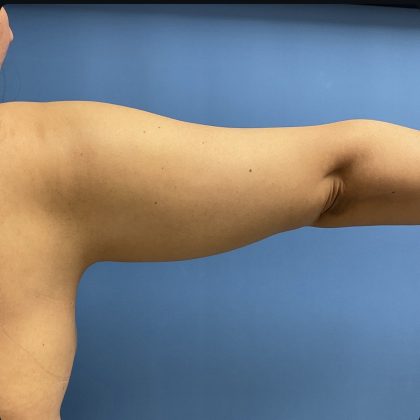 Liposuction Before & After Patient #15186