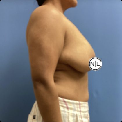 Breast Reduction Before & After Patient #15428