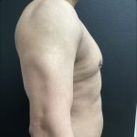 Gynecomastia Before & After Patient #15429