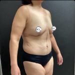 Breast Lift Before & After Patient #14844