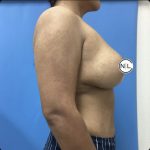 Breast Reduction Before & After Patient #15428