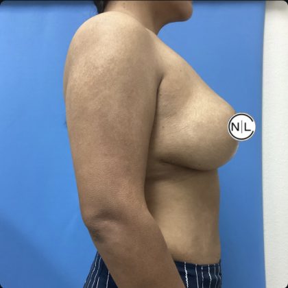 Breast Reduction Before & After Patient #15428