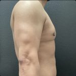 Gynecomastia Before & After Patient #15429