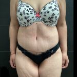 Abdominoplasty Before & After Patient #14760