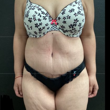 Abdominoplasty Before & After Patient #14760