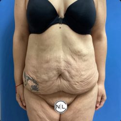 Abdominoplasty Before & After Patient #14760