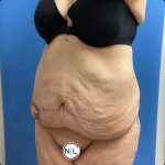 Abdominoplasty Before & After Patient #14760