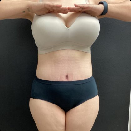 Abdominoplasty Before & After Patient #14771