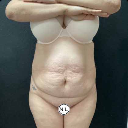 Abdominoplasty Before & After Patient #14771