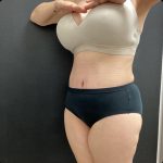 Abdominoplasty Before & After Patient #14771
