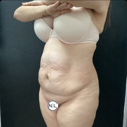 Abdominoplasty Before & After Patient #14771