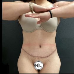 Abdominoplasty Before & After Patient #14393