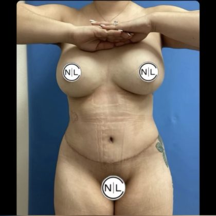 Abdominoplasty Before & After Patient #14679