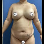 Abdominoplasty Before & After Patient #14679