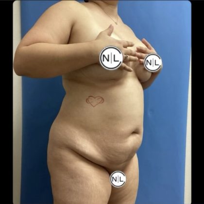 Abdominoplasty Before & After Patient #14679