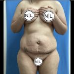 Abdominoplasty Before & After Patient #14692