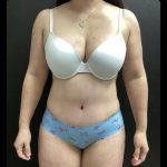Abdominoplasty Before & After Patient #14703
