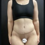 Abdominoplasty Before & After Patient #14712