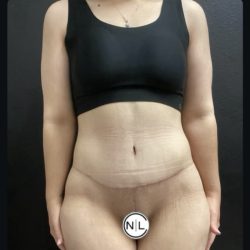 Abdominoplasty Before & After Patient #14712