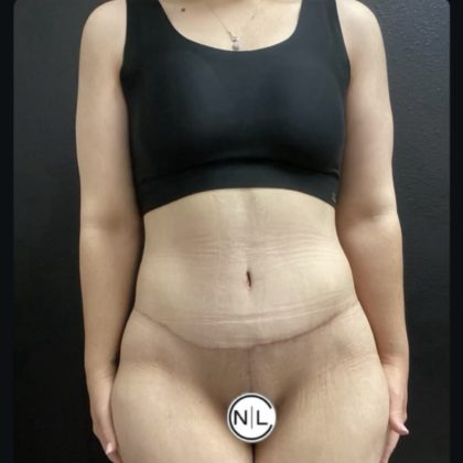 Abdominoplasty Before & After Patient #14712