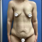 Abdominoplasty Before & After Patient #14712