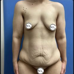 Abdominoplasty Before & After Patient #14712