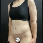 Abdominoplasty Before & After Patient #14712