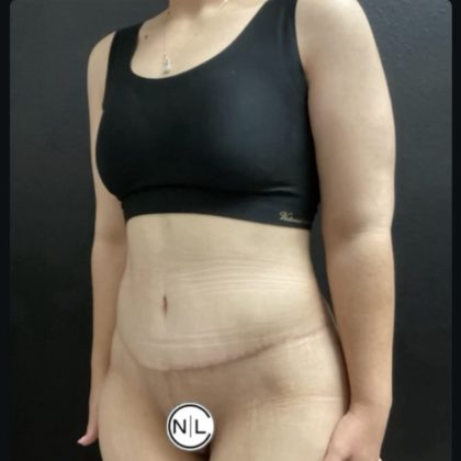 Abdominoplasty Before & After Patient #14712