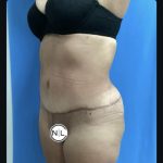 Abdominoplasty Before & After Patient #14725