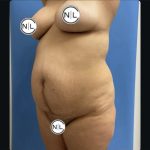 Abdominoplasty Before & After Patient #14725