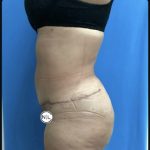 Abdominoplasty Before & After Patient #14725